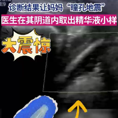 7岁女童阴道炎竟是精华液惹祸