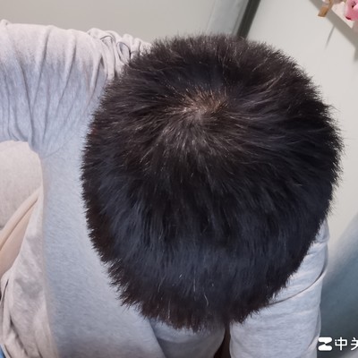 兄弟们帮忙看看我头顶秃了吗