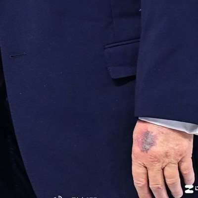 特朗普左手背现新瘀青引热议