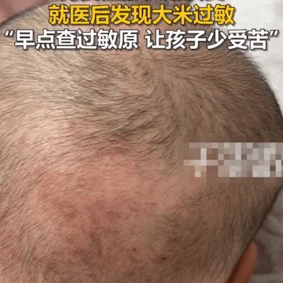 男婴湿疹竟因大米过敏