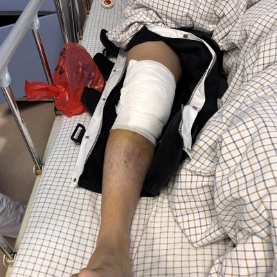 前交叉韧带断裂重建中的心理挑战