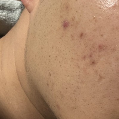 痤疮痘印解决方法