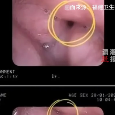 福建男子睡眠舌根后坠致频繁断气