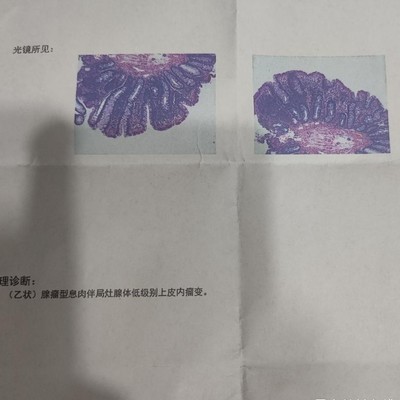 肠镜息肉报告引发的焦虑