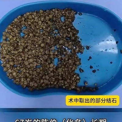 67岁阿伯膀胱惊现600颗结石