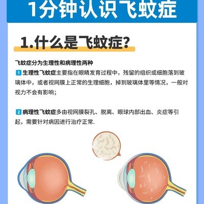 飞蚊症自测与护眼指南