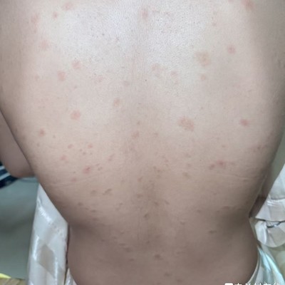 球友长了这个，会感染吗？