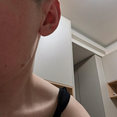 痤疮改善方法探讨